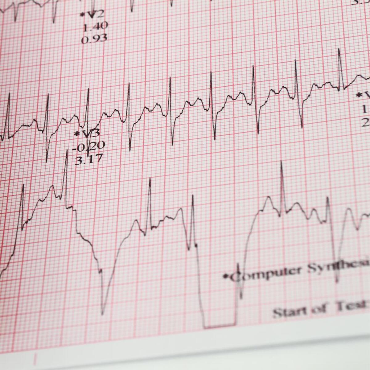 Electrocardiogram (ECG) printout with computer-synthesized waveforms on grid paper.